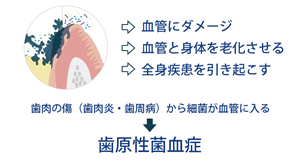 種々の慢性病の原因 - 歯原性菌血症