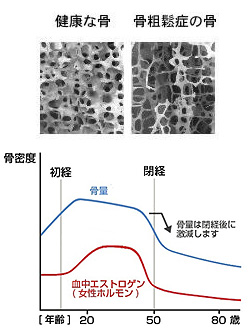 健康な骨 骨そしょう症骨