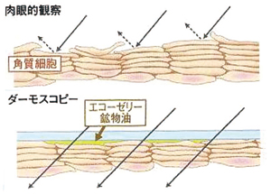 エコーゼリーの使用で皮膚表面から乱反射が抑えられ、肉眼で認識できない表皮から真皮上層までの構造を透見できる。