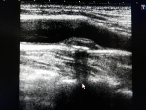 頸動脈のエコー画像。上の黒い部分が血液の通り道。中央の盛り上がりがプラーク。