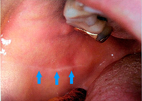 （頬の内側）頬粘膜の咬合線